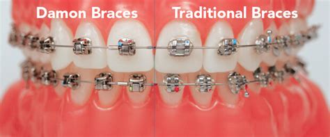 traditional braces vs damon system